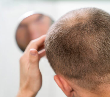 Male hair transplant balding