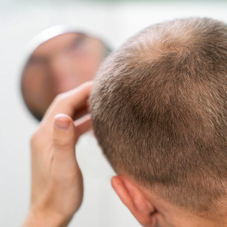 Male hair transplant balding