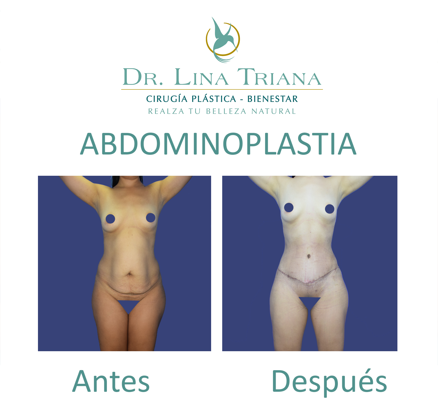 Abdominoplastia - Galerias Foto Estudio