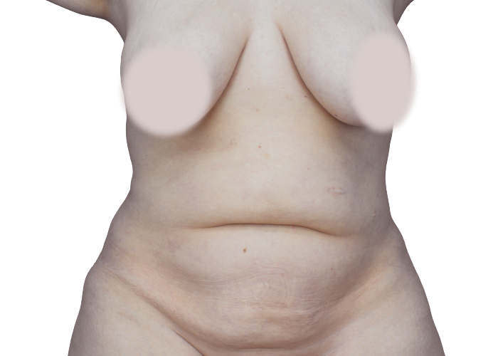 Front view of a nude midsection showing abdominal skin folds and natural contour, nipples obscured with pasties for modesty.