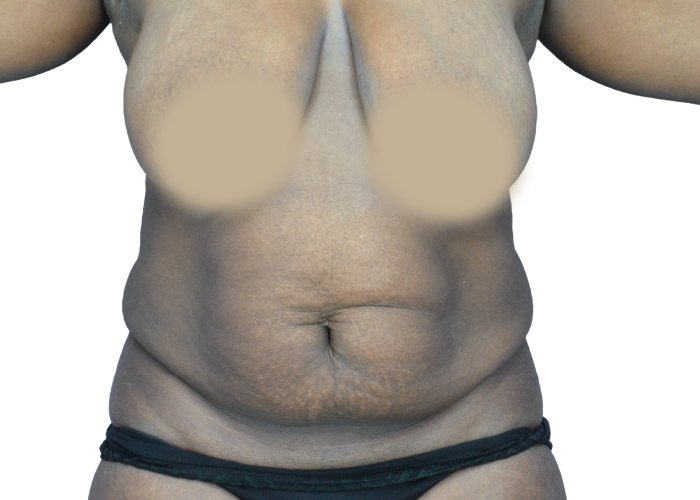 Front view of an adult's bare torso from shoulders to hips, nipples blurred, showing a soft abdomen and dark underwear at the hips.