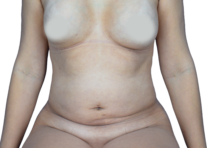 Front view of a woman's torso with breasts covered by white pasties, displaying loose abdominal skin and folds.