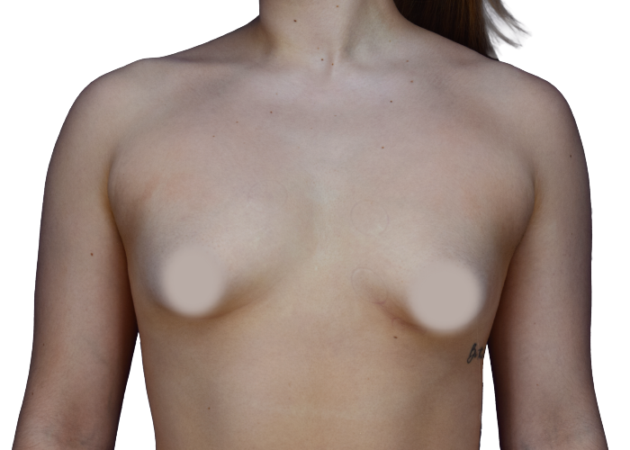 Front view of a topless woman's chest with nipples blurred for modesty.