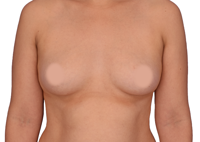 Front view of an adult woman's topless torso with nipples blurred for modesty.