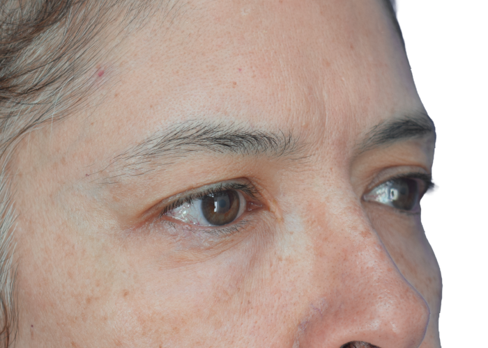 Close-up of a person's eyes and surrounding skin, showing brown irises and freckles on the cheek and nose.