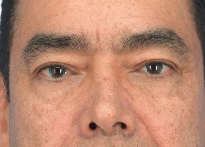 Close-up of a man's face focusing on the eyes and nose, showing textured skin and dark eyebrows.