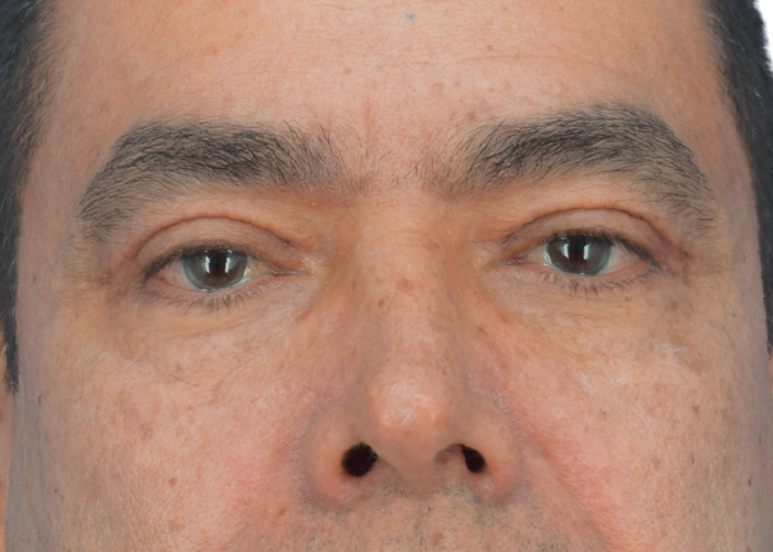 Close-up of a man's face focusing on the eyes and nose, showing skin texture and light freckles around the nose area.