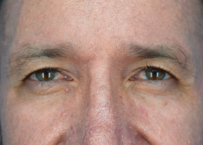 Close-up of a man's face around the eyes showing brown eyes, the nose bridge, and textured skin with fine wrinkles around the eyes.