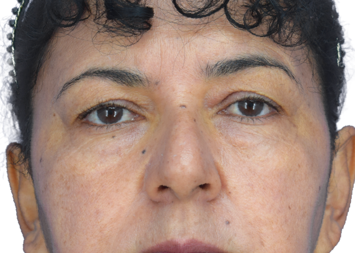Close-up of a woman's face with a neutral expression, showing facial skin texture, moles, and dark eyebrows.