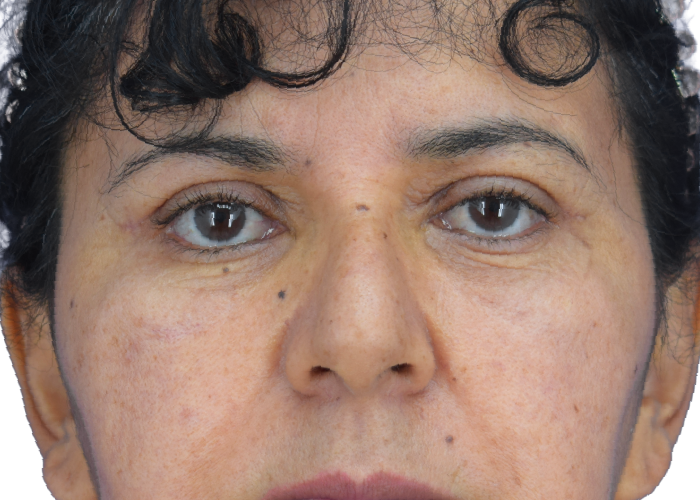 Close-up portrait of a woman looking straight ahead, showing facial features and skin texture (eyes, nose, mouth).