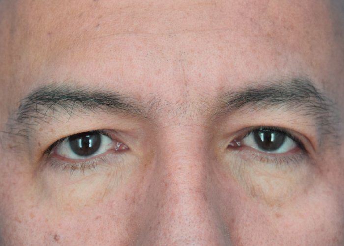 Close-up of a person's eyes looking straight ahead, showing brown irises, lashes, and textured skin around the eyelids.