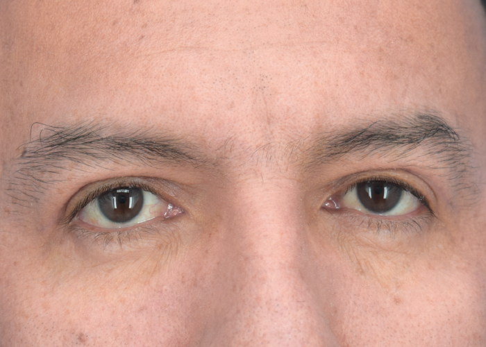 Close-up of a man's eyes looking straight ahead with a neutral expression.