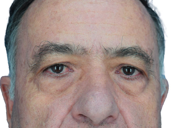 Close-up of a man's face from the eyes to the nose, showing tired eyes and gray eyebrows.