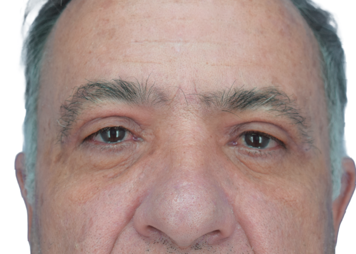 Close-up of a middle-aged man's face focusing on eyes and nose with a neutral expression.