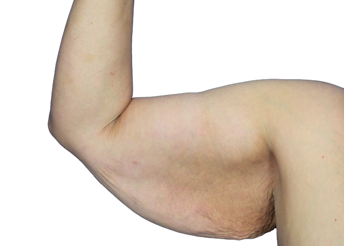 Close-up of a flexed bare upper arm showing sagging skin and a small crease on the inner side of the arm.
