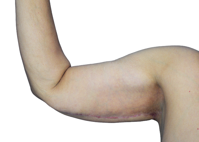 Inner side of a bent arm showing a long healed surgical scar along the elbow area.