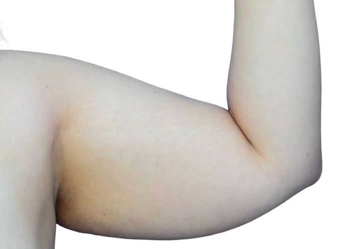 Close-up of a pale upper arm with faint stretch marks along the inner crease.