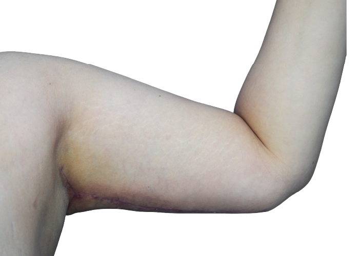Close-up of a pale upper arm bent at the elbow, showing a healed surgical scar along the armpit area.