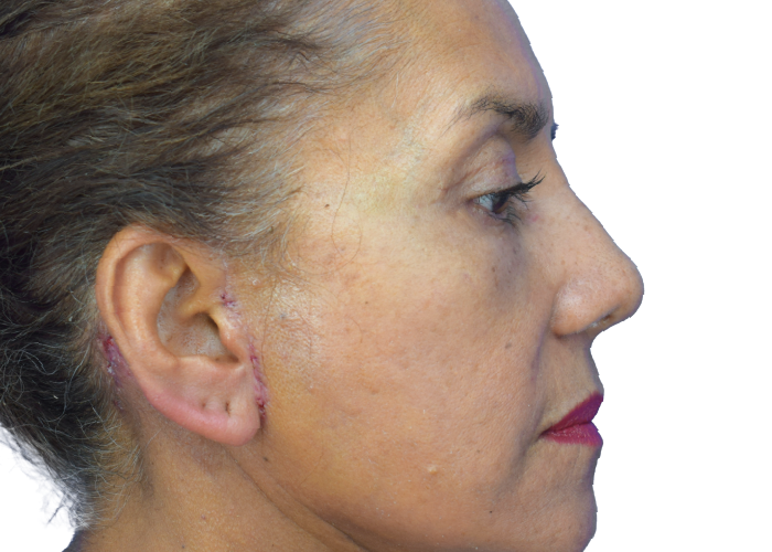 Left-profile view of a woman with a surgical scar along the ear and temple, wearing pink lipstick against a white background