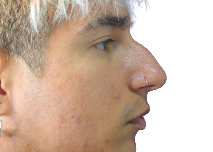 Side profile of a young man facing right, with light hair and mild facial acne visible on his cheek and jaw.
