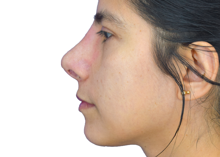 Profile view of a young woman facing left, showing her nose, lips, and jawline against a white background.