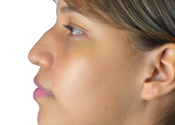 Profile view of a woman facing left, showing nose, lips, and ear against a white background.
