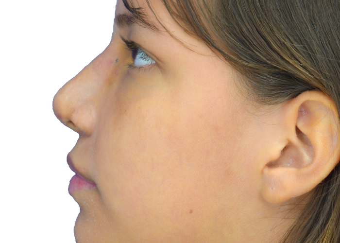 Profile view of a young woman facing left, showing nose, lips, cheek, and ear in a side portrait.
