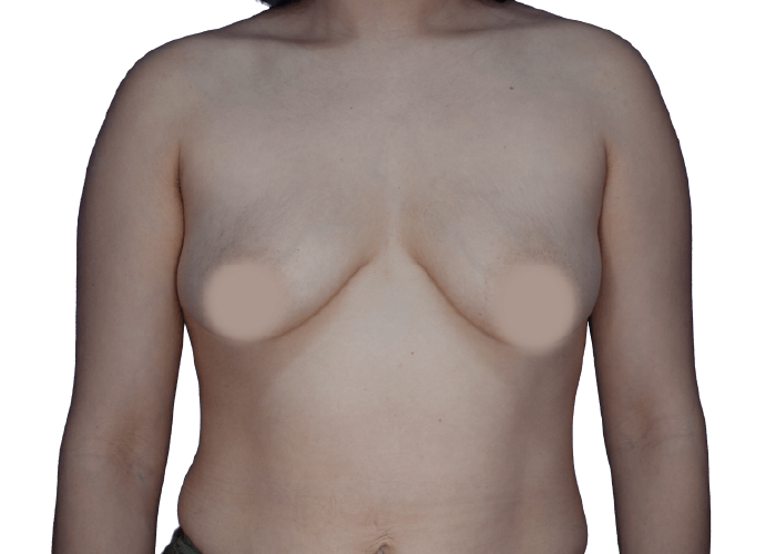 Front view of a topless adult with nipples covered by round pasties or censor discs, facing forward.