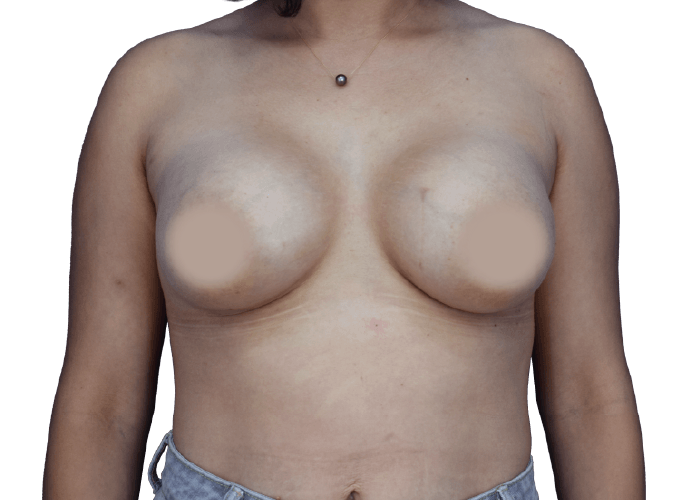Front view of a topless person’s chest with nipples blurred for modesty.